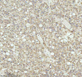 Immunohistochemical staining of NRTN using anti-NRTN antibody. NRTN was detected in a paraffin-embedded section of human thyroid papillary carcinoma tissue. Heat mediated antigen retrieval was performed in EDTA buffer (pH 8.0, epitope retrieval solution). The tissue section was blocked with 10% goat serum. The tissue section was then incubated with 2 ug/ml rabbit anti-NRTN antibody overnight at 4oC. Peroxidase Conjugated Goat Anti-rabbit IgG was used as secondary antibody and incubated for 30 min at 37oC.