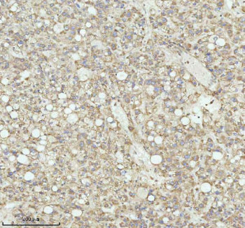 Immunohistochemical staining of NRTN using anti-NRTN antibody. NRTN was detected in a paraffin-embedded section of human thyroid papillary carcinoma tissue. Heat mediated antigen retrieval was performed in EDTA buffer (pH 8.0, epitope retrieval solution). The tissue section was blocked with 10% goat serum. The tissue section was then incubated with 2 ug/ml rabbit anti-NRTN antibody overnight at 4oC. Peroxidase Conjugated Goat Anti-rabbit IgG was used as secondary antibody and incubated for 30 min at 37oC.