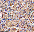 Immunohistochemical staining of TRIM40 using anti-TRIM40 antibody. TRIM40 was detected in a paraffin-embedded section of human liver cancer tissue. Heat mediated antigen retrieval was performed in EDTA buffer (pH 8.0, epitope retrieval solution). The tissue section was blocked with 10% goat serum. The tissue section was then incubated with 2 ug/ml rabbit anti-TRIM40 antibody overnight at 4oC. Peroxidase Conjugated Goat Anti-rabbit IgG was used as secondary antibody and incubated for 30 min at 37oC.