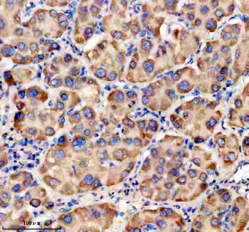 Immunohistochemical staining of TRIM40 using anti-TRIM40 antibody. TRIM40 was detected in a paraffin-embedded section of human liver cancer tissue. Heat mediated antigen retrieval was performed in EDTA buffer (pH 8.0, epitope retrieval solution). The tissue section was blocked with 10% goat serum. The tissue section was then incubated with 2 ug/ml rabbit anti-TRIM40 antibody overnight at 4oC. Peroxidase Conjugated Goat Anti-rabbit IgG was used as secondary antibody and incubated for 30 min at 37oC.