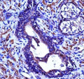 ACTG2 antibody immunohistochemistry analysis in formalin fixed and paraffin embedded human prostate cancinoma.