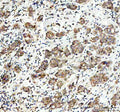 IHC staining of FFPE human breast cancer tissue with MAP3K1 antibody. HIER: boil tissue sections in pH8 EDTA for 20 min and allow to cool before testing.