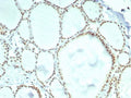 IHC staining of FFPE human thyroid tissue with ERCC1 antibody (clone ERCC1/7596). HIER: boil tissue sections in pH 9 10mM Tris with 1mM EDTA for 20 min and allow to cool before testing.