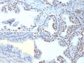 IHC staining of FFPE human prostate tissue with recombinant TDP43 antibody (clone TARDP/9299R). Inset: PBS used in place of primary Ab (secondary Ab negative control). HIER: boil tissue sections in pH 9 10mM Tris with 1mM EDTA for 20 min and allow to cool before testing.