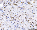 IHC staining of FFPE human gastric cancer tissue with Fibroblast Growth Factor 2 antibody. HIER: boil tissue sections in pH8 EDTA for 20 min and allow to cool before testing.