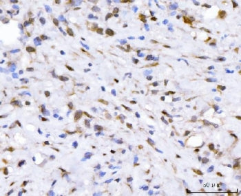 IHC staining of FFPE human gastric cancer tissue with Fibroblast Growth Factor 2 antibody. HIER: boil tissue sections in pH8 EDTA for 20 min and allow to cool before testing.