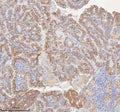 IHC staining of FFPE human thyroid papillary carcinoma tissue with MINDY4 antibody. HIER: boil tissue sections in pH8 EDTA for 20 min and allow to cool before testing.