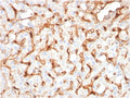 IHC staining of FFPE human hepatocellular carcinoma with Complement C1q B-Chain antibody. HIER: boil tissue sections in pH 9 10mM Tris with 1mM EDTA for 20 min and allow to cool before testing.