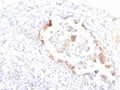 IHC testing of FFPE human lung carcinoma with Lewis y antibody (clone LWY/1463). Required HIER: boil tissue sections in 10mM citrate buffer, pH 6, for 10-20 min.