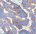 Immunohistochemical staining of IER3 using anti-IER3 antibody. IER3 was detected in a paraffin-embedded section of human stomach cancer tissue. Heat mediated antigen retrieval was performed in EDTA buffer (pH 8.0, epitope retrieval solution). The tissue section was blocked with 10% goat serum. The tissue section was then incubated with 2 ug/ml rabbit anti-IER3 antibody overnight at 4oC. Peroxidase Conjugated Goat Anti-rabbit IgG was used as secondary antibody and incubated for 30 min at 37oC.