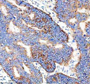 Immunohistochemical staining of IER3 using anti-IER3 antibody. IER3 was detected in a paraffin-embedded section of human stomach cancer tissue. Heat mediated antigen retrieval was performed in EDTA buffer (pH 8.0, epitope retrieval solution). The tissue section was blocked with 10% goat serum. The tissue section was then incubated with 2 ug/ml rabbit anti-IER3 antibody overnight at 4oC. Peroxidase Conjugated Goat Anti-rabbit IgG was used as secondary antibody and incubated for 30 min at 37oC.