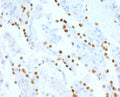 IHC staining of human lung adenocarcinoma with recombinant NKX2.1 antibody (clone HBNK2-2R). Required HIER: boil tissue sections in pH6, 10mM citrate buffer, for 10-20 min followed by cooling at RT for 20 min.