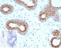 IHC staining of FFPE human breast carcinoma tissue with BAP1 antibody (clone BAP1/9795R). Inset: PBS used in place of primary Ab (secondary Ab negative control). HIER: boil tissue sections in pH 9 10mM Tris with 1mM EDTA for 20 min and allow to cool before testing.