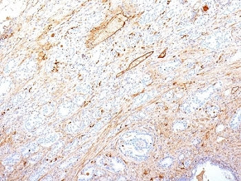IHC: Formalin-fixed, paraffin-embedded human pancreatic adenocarcinoma stained with Fibronectin antibody (SPM246).