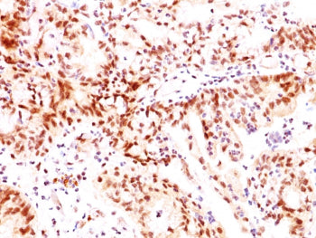 IHC testing of human breast cancer stained with Estrogen Receptor beta antibody (ERb455).