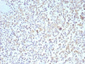 IHC staining of FFPE human Hodgkins lymphoma tissue with recombinant Bcl-X antibody (clone BCL2L1/9221R). HIER: boil tissue sections in pH 9 10mM Tris with 1mM EDTA for 20 min and allow to cool before testing.