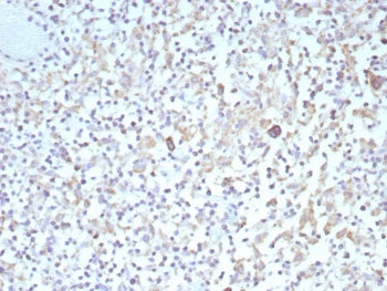 IHC staining of FFPE human Hodgkins lymphoma tissue with recombinant Bcl-X antibody (clone BCL2L1/9221R). HIER: boil tissue sections in pH 9 10mM Tris with 1mM EDTA for 20 min and allow to cool before testing.