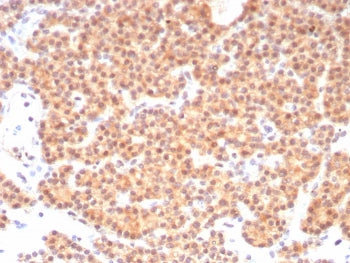 IHC staining of FFPE human parathyroid tissue with c-RET antibody (clone RET/8790). HIER: boil tissue sections in pH 9 10mM Tris with 1mM EDTA for 20 min and allow to cool before testing.