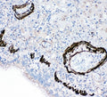 IHC-P: FABP6 antibody testing of human lung cancer tissue
