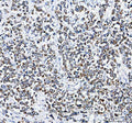 IHC analysis of PLD5 using anti-PLD5 antibody. PLD5 was detected in a paraffin-embedded section of human prostate cancer tissue. Heat mediated antigen retrieval was performed in EDTA buffer (pH 8.0, epitope retrieval solution). The tissue section was blocked with 10% goat serum. The tissue section was then incubated with 2 ug/ml rabbit anti-PLD5 antibody overnight at 4oC. Peroxidase Conjugated Goat Anti-rabbit IgG was used as secondary antibody and incubated for 30 min at 37oC.