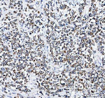 IHC analysis of PLD5 using anti-PLD5 antibody. PLD5 was detected in a paraffin-embedded section of human prostate cancer tissue. Heat mediated antigen retrieval was performed in EDTA buffer (pH 8.0, epitope retrieval solution). The tissue section was blocked with 10% goat serum. The tissue section was then incubated with 2 ug/ml rabbit anti-PLD5 antibody overnight at 4oC. Peroxidase Conjugated Goat Anti-rabbit IgG was used as secondary antibody and incubated for 30 min at 37oC.