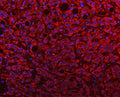 Immunofluorescent staining of FFPE human liver cancer with PGP antibody (red) and DAPI nuclear stain (blue). HIER: steam section in pH8 EDTA buffer for 20 min.