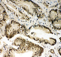 IHC staining of FFPE human colon cancer tissue with PIN1 antibody, HRP-secondary and DAB substrate. HIER: boil tissue sections in pH8 EDTA for 20 min and allow to cool before testing.