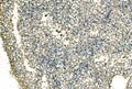 IHC staining of FFPE human renal cell carcinoma tissue with NEDD4 antibody. HIER: boil tissue sections in pH8 EDTA for 20 min and allow to cool before testing.
