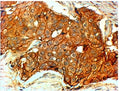 IHC staining of HER+ FFPE human breast cancer with HER2 antibody at 4ug/ml. HIER: Steamed with pH6 citrate buffer, HRP-staining.