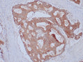 IHC staining of FFPE human colon adenocarcinoma with EpCAM antibody (clone Ber-EP4). HIER: boil tissue sections in pH 9 10mM Tris with 1mM EDTA for 10-20 min and allow to cool before testing.
