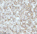 Immunohistochemical staining of GAREM1 using anti-GAREM1 antibody. GAREM1 was detected in a paraffin-embedded section of human liver cancer tissue. Heat mediated antigen retrieval was performed in EDTA buffer (pH 8.0, epitope retrieval solution). The tissue section was blocked with 10% goat serum. The tissue section was then incubated with 2 ug/ml rabbit anti-GAREM1 antibody overnight at 4oC. Peroxidase Conjugated Goat Anti-rabbit IgG was used as secondary antibody and incubated for 30 min at 37oC.