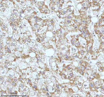 Immunohistochemical staining of GAREM1 using anti-GAREM1 antibody. GAREM1 was detected in a paraffin-embedded section of human liver cancer tissue. Heat mediated antigen retrieval was performed in EDTA buffer (pH 8.0, epitope retrieval solution). The tissue section was blocked with 10% goat serum. The tissue section was then incubated with 2 ug/ml rabbit anti-GAREM1 antibody overnight at 4oC. Peroxidase Conjugated Goat Anti-rabbit IgG was used as secondary antibody and incubated for 30 min at 37oC.