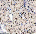Immunohistochemical staining of TRIM47 using anti-TRIM47 antibody. TRIM47 was detected in a paraffin-embedded section of human liver cancer tissue. Heat mediated antigen retrieval was performed in EDTA buffer (pH 8.0, epitope retrieval solution). The tissue section was blocked with 10% goat serum. The tissue section was then incubated with 2 ug/ml rabbit anti-TRIM47 antibody overnight at 4oC. Peroxidase Conjugated Goat Anti-rabbit IgG was used as secondary antibody and incubated for 30 min at 37oC.