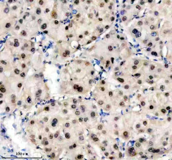Immunohistochemical staining of TRIM47 using anti-TRIM47 antibody. TRIM47 was detected in a paraffin-embedded section of human liver cancer tissue. Heat mediated antigen retrieval was performed in EDTA buffer (pH 8.0, epitope retrieval solution). The tissue section was blocked with 10% goat serum. The tissue section was then incubated with 2 ug/ml rabbit anti-TRIM47 antibody overnight at 4oC. Peroxidase Conjugated Goat Anti-rabbit IgG was used as secondary antibody and incubated for 30 min at 37oC.