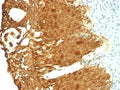 IHC: Formalin-fixed, paraffin-embedded human cervical carcinoma stained with Cytokeratin 19 antibody (KRT19/799 + KRT19/800).