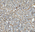 IHC staining of FFPE human liver cancer tissue with Annexin A2 antibody, HRP-secondary and DAB substrate. HIER: boil tissue sections in pH8 EDTA for 20 min and allow to cool before testing.
