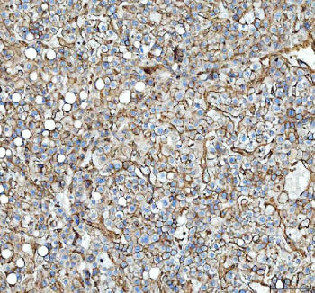 IHC staining of FFPE human liver cancer tissue with Annexin A2 antibody, HRP-secondary and DAB substrate. HIER: boil tissue sections in pH8 EDTA for 20 min and allow to cool before testing.