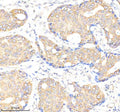Immunohistochemical staining of BMPR1A using anti-BMPR1A antibody. BMPR1A was detected in a paraffin-embedded section of human breast cancer tissue. Heat mediated antigen retrieval was performed in EDTA buffer (pH 8.0, epitope retrieval solution). The tissue section was blocked with 10% goat serum. The tissue section was then incubated with 2 ug/ml rabbit anti-BMPR1A antibody overnight at 4oC. Peroxidase Conjugated Goat Anti-rabbit IgG was used as secondary antibody and incubated for 30 min at 37oC.