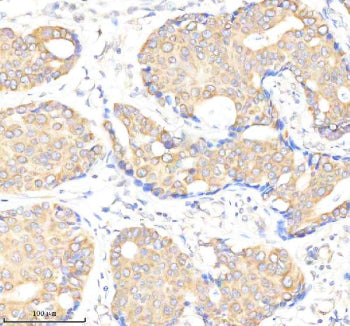 Immunohistochemical staining of BMPR1A using anti-BMPR1A antibody. BMPR1A was detected in a paraffin-embedded section of human breast cancer tissue. Heat mediated antigen retrieval was performed in EDTA buffer (pH 8.0, epitope retrieval solution). The tissue section was blocked with 10% goat serum. The tissue section was then incubated with 2 ug/ml rabbit anti-BMPR1A antibody overnight at 4oC. Peroxidase Conjugated Goat Anti-rabbit IgG was used as secondary antibody and incubated for 30 min at 37oC.