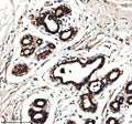 Immunohistochemical staining of RALGAPB using anti-RALGAPB antibody. RALGAPB was detected in a paraffin-embedded section of human breast cancer tissue. Heat mediated antigen retrieval was performed in EDTA buffer (pH 8.0, epitope retrieval solution). The tissue section was blocked with 10% goat serum. The tissue section was then incubated with 2 ug/ml rabbit anti-RALGAPB antibody overnight at 4oC. Peroxidase Conjugated Goat Anti-rabbit IgG was used as secondary antibody and incubated for 30 min at 37oC.