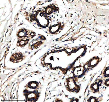 Immunohistochemical staining of RALGAPB using anti-RALGAPB antibody. RALGAPB was detected in a paraffin-embedded section of human breast cancer tissue. Heat mediated antigen retrieval was performed in EDTA buffer (pH 8.0, epitope retrieval solution). The tissue section was blocked with 10% goat serum. The tissue section was then incubated with 2 ug/ml rabbit anti-RALGAPB antibody overnight at 4oC. Peroxidase Conjugated Goat Anti-rabbit IgG was used as secondary antibody and incubated for 30 min at 37oC.