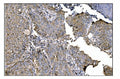 IHC staining of FFPE human lung cancer tissue with Ornithine Aminotransferase antibody. HIER: boil tissue sections in pH8 EDTA for 20 min and allow to cool before testing.