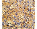 IHC analysis of FFPE human hepatocarcinoma with Cyclin A2 antibody