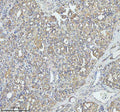 Immunohistochemical staining of TOM1 using anti-TOM1 antibody. TOM1 was detected in a paraffin-embedded section of human thyroid cancer tissue. Heat mediated antigen retrieval was performed in EDTA buffer (pH 8.0, epitope retrieval solution). The tissue section was blocked with 10% goat serum. The tissue section was then incubated with 2 ug/ml rabbit anti-TOM1 antibody overnight at 4oC. Peroxidase Conjugated Goat Anti-rabbit IgG was used as secondary antibody and incubated for 30 min at 37oC.