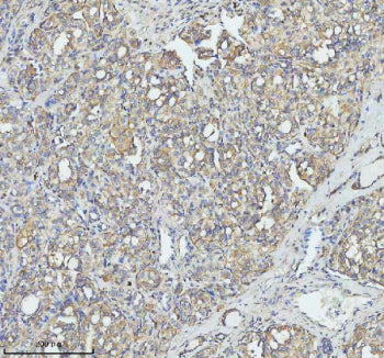 Immunohistochemical staining of TOM1 using anti-TOM1 antibody. TOM1 was detected in a paraffin-embedded section of human thyroid cancer tissue. Heat mediated antigen retrieval was performed in EDTA buffer (pH 8.0, epitope retrieval solution). The tissue section was blocked with 10% goat serum. The tissue section was then incubated with 2 ug/ml rabbit anti-TOM1 antibody overnight at 4oC. Peroxidase Conjugated Goat Anti-rabbit IgG was used as secondary antibody and incubated for 30 min at 37oC.
