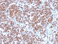 IHC staining of FFPE human mantle cell carcinoma with recombinant Cyclin D1 antibody (clone CCND1/3370R). HIER: boil tissue sections in pH 9 10mM Tris with 1mM EDTA for 20 min and allow to cool before testing.
