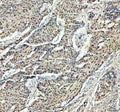 Immunohistochemical staining of PSME3 using anti-PSME3 antibody. PSME3 was detected in a paraffin-embedded section of human cervical cancer tissue. Heat mediated antigen retrieval was performed in EDTA buffer (pH 8.0, epitope retrieval solution). The tissue section was blocked with 10% goat serum. The tissue section was then incubated with 2 ug/ml rabbit anti-PSME3 antibody overnight at 4oC. Peroxidase Conjugated Goat Anti-rabbit IgG was used as secondary antibody and incubated for 30 min at 37oC.