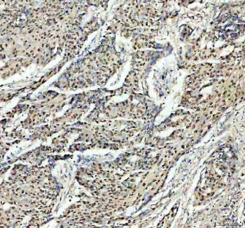 Immunohistochemical staining of PSME3 using anti-PSME3 antibody. PSME3 was detected in a paraffin-embedded section of human cervical cancer tissue. Heat mediated antigen retrieval was performed in EDTA buffer (pH 8.0, epitope retrieval solution). The tissue section was blocked with 10% goat serum. The tissue section was then incubated with 2 ug/ml rabbit anti-PSME3 antibody overnight at 4oC. Peroxidase Conjugated Goat Anti-rabbit IgG was used as secondary antibody and incubated for 30 min at 37oC.