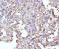 IHC staining of FFPE human histiocytoma with recombinant TNF alpha antibody (clone RMTNFA-1). Required HIER: steam sections in pH 9 10mM Tris with 1mM EDTA for 10-20 min.