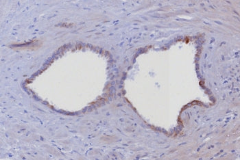 IHC staining of FFPE human prostate tissue with Cytokeratin 6 antibody (clone KRT6/8198R). HIER: boil tissue sections in pH 9 10mM Tris with 1mM EDTA for 20 min and allow to cool before testing.